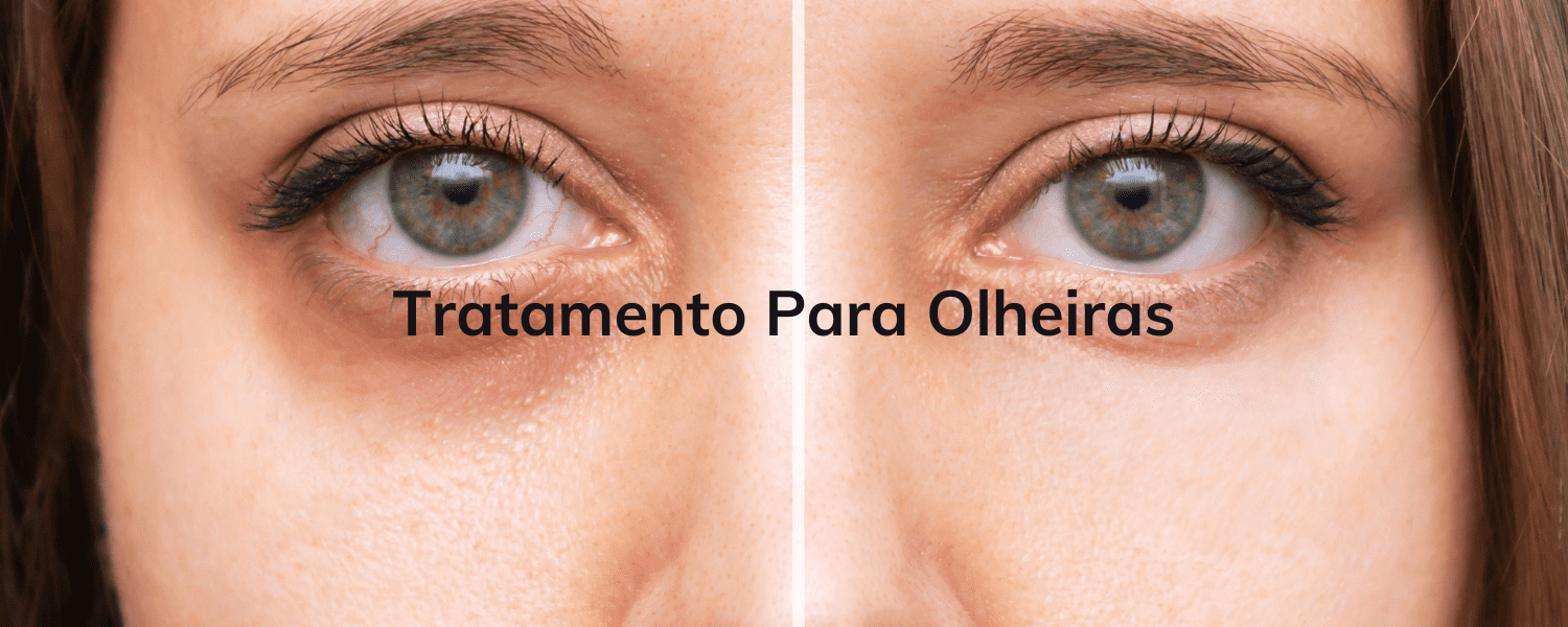 Preenchimento de Olheiras: Ácido Hialurônico ou Fios de PDO?