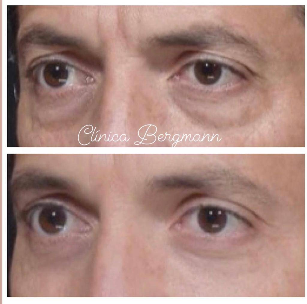 Cirurgia de Blefaroplastia: Solução Definitiva para Bolsas sob os Olhos?