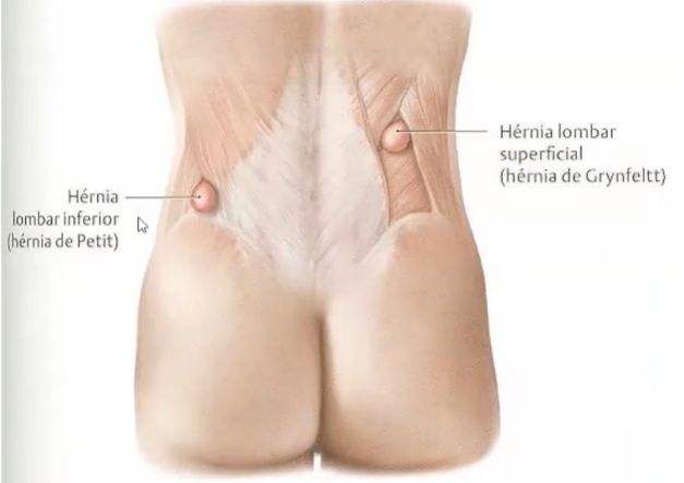 Como Diagnosticar e Tratar Hérnias Lombares: Um Olhar Detalhado