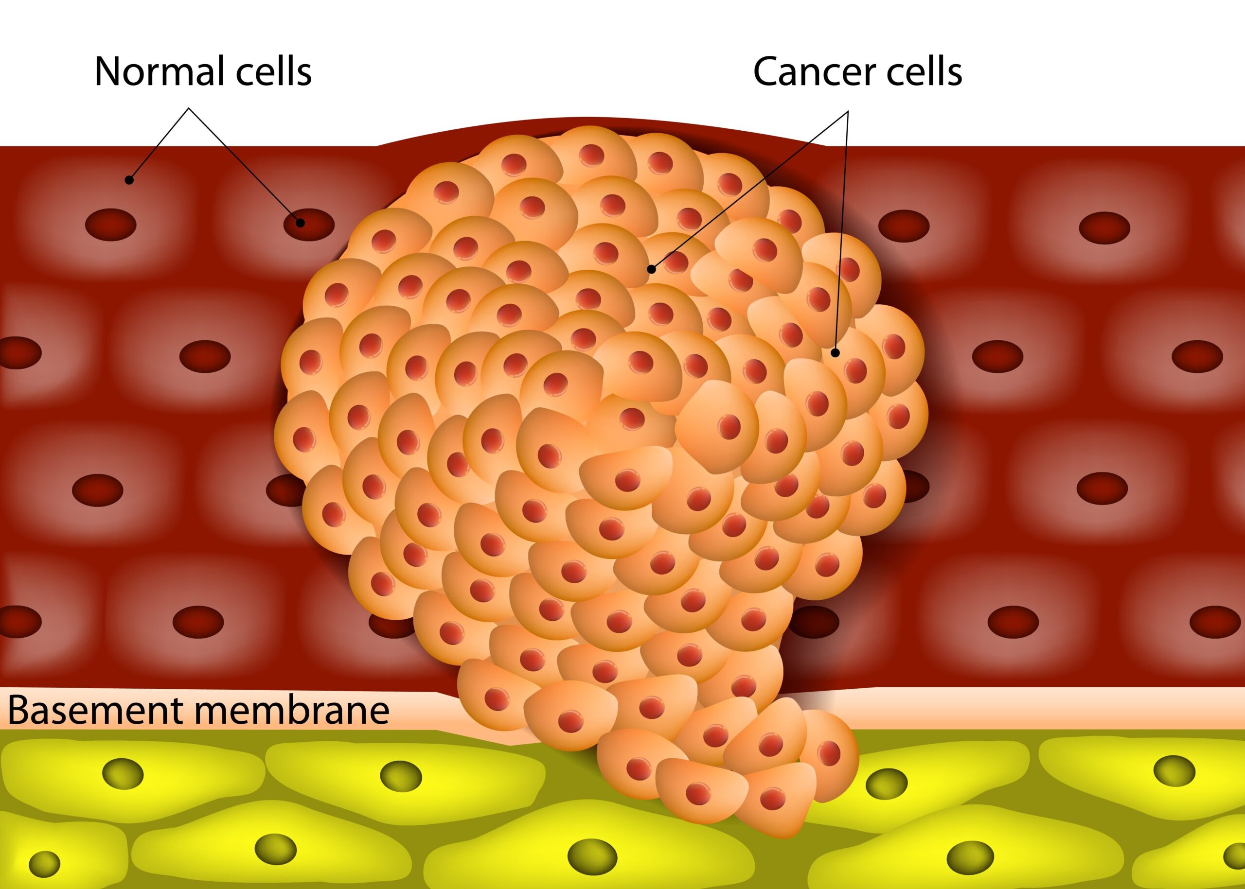 câncer versus tumor benigno