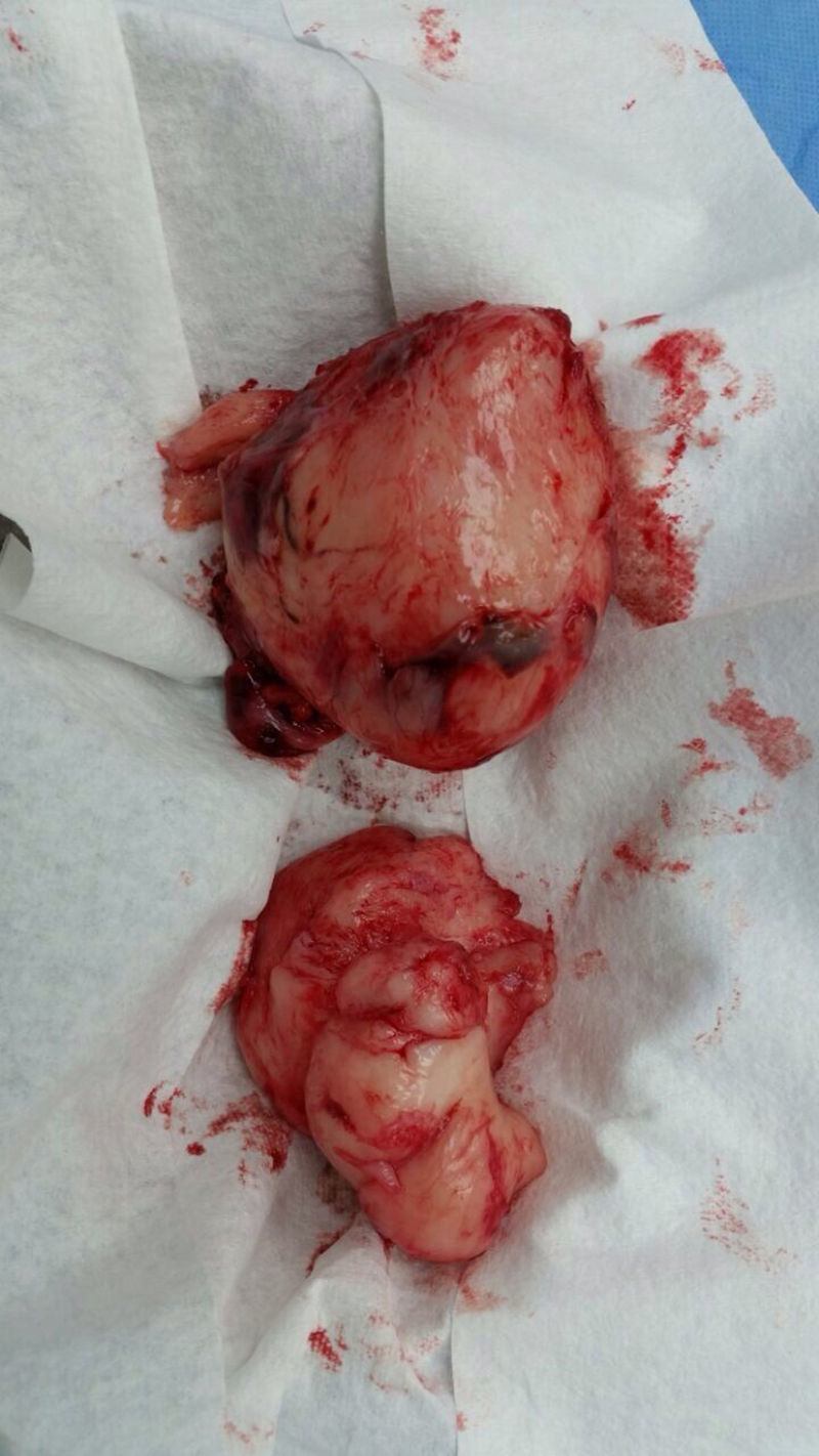 tratamento de neoplasia maligna