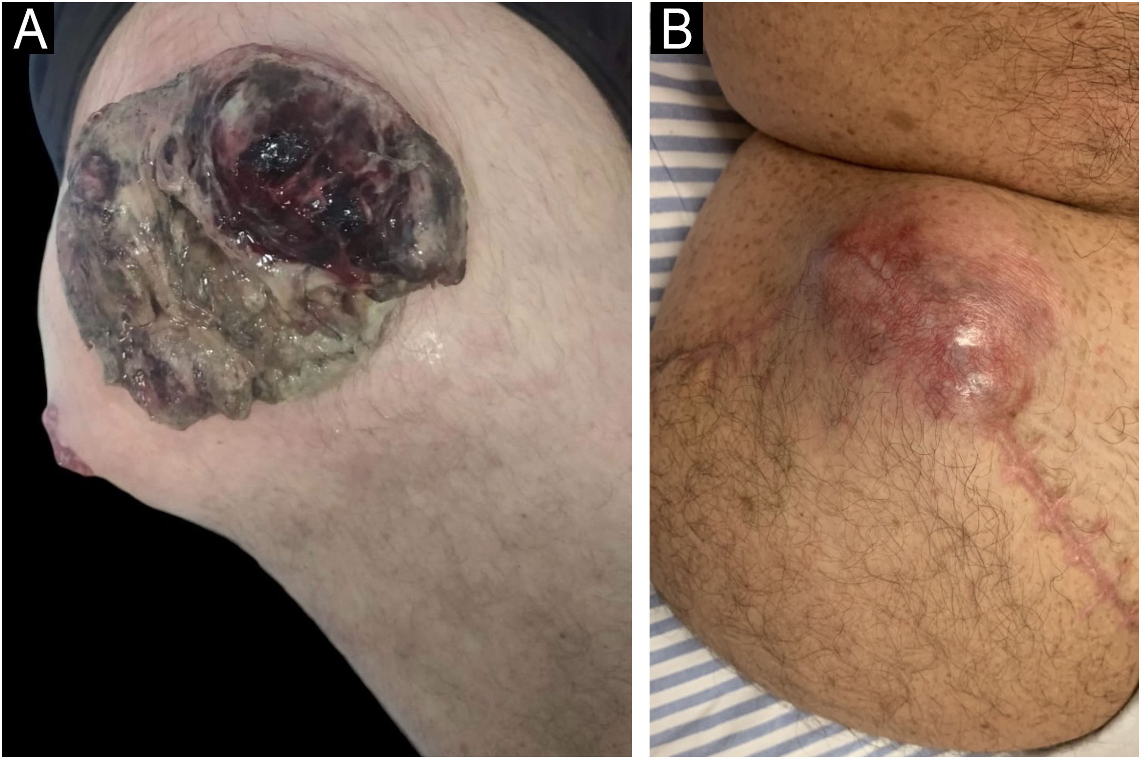sinais de tumor maligno