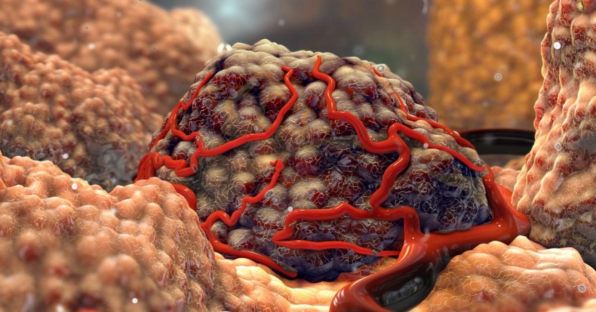 tratamento de neoplasia maligna