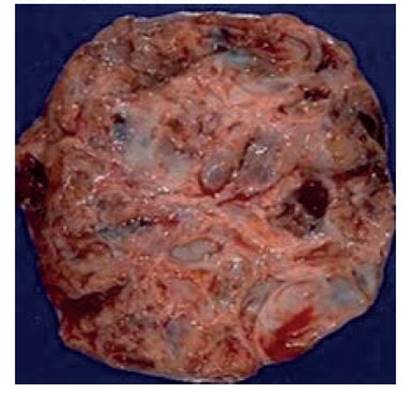 biópsia para confirmação de tumor