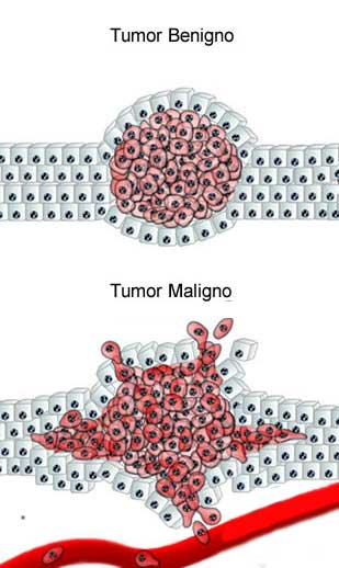 Tumor Maligno