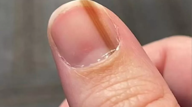 Deficiências Nutricionais e Unhas Onduladas: O Que Você Precisa Saber