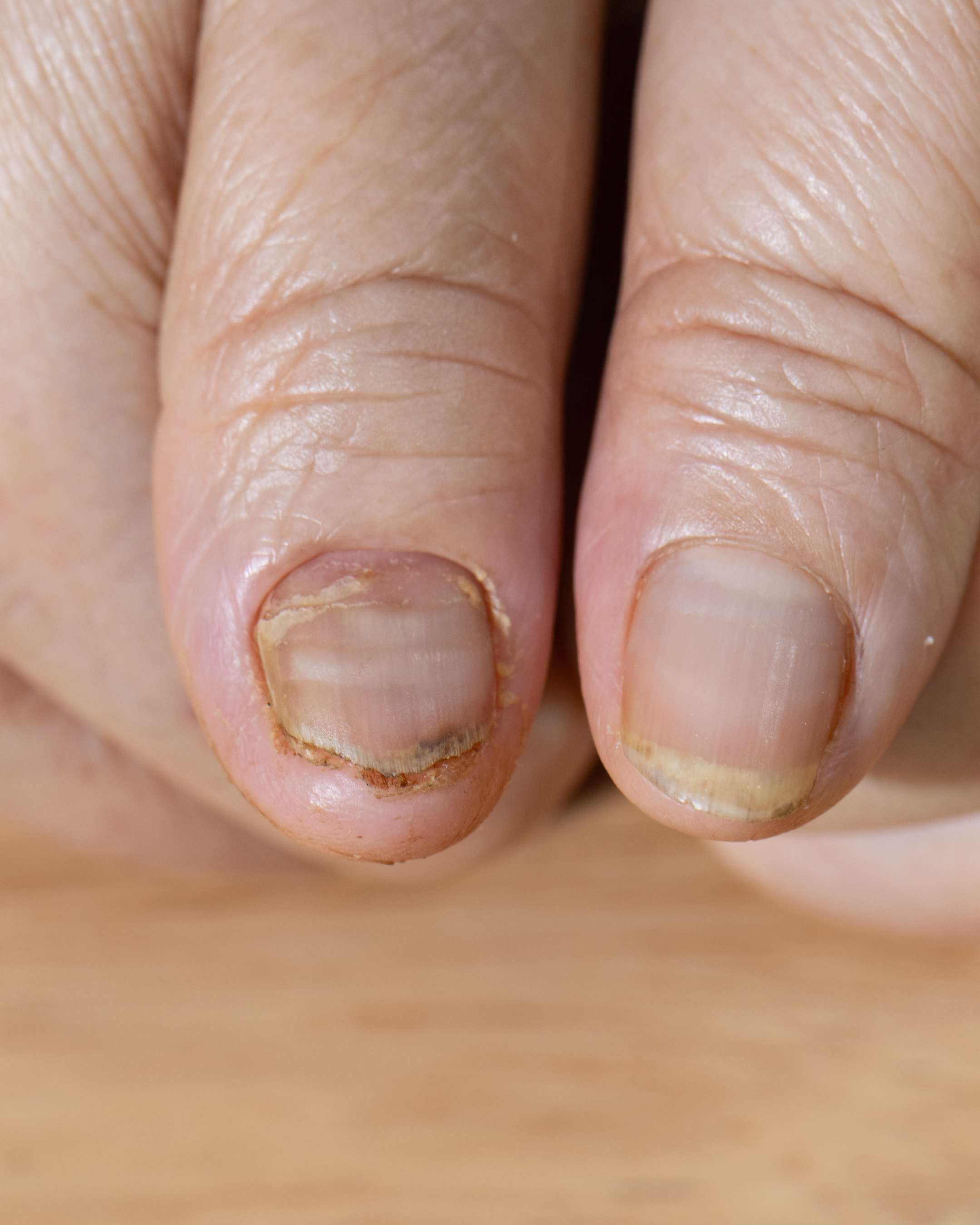 Descubra as 7 Principais Causas das Unhas Onduladas e Como Tratar