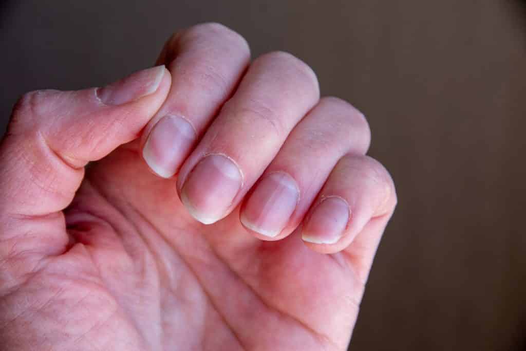 Unhas Onduladas: Sinais do Seu Corpo e Soluções Eficazes