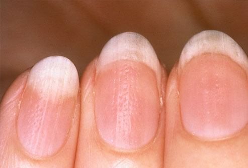 Deficiências Nutricionais e Unhas Onduladas: O Que Você Precisa Saber