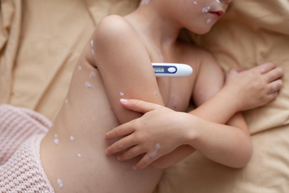 Catapora: Mitos e Verdades sobre a Doença e a Vacinação