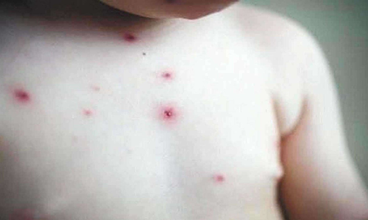 Vacinação contra Varicela no SUS vs. Clínicas Particulares: Qual a Diferença?