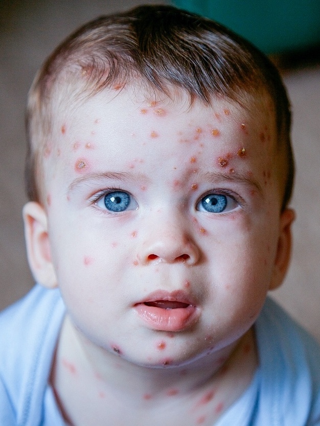 A Importância da Vacina contra Catapora para Adultos e Crianças