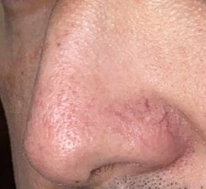 Alimentos e Suplementos para Fortalecer os Vasos Sanguíneos da Face