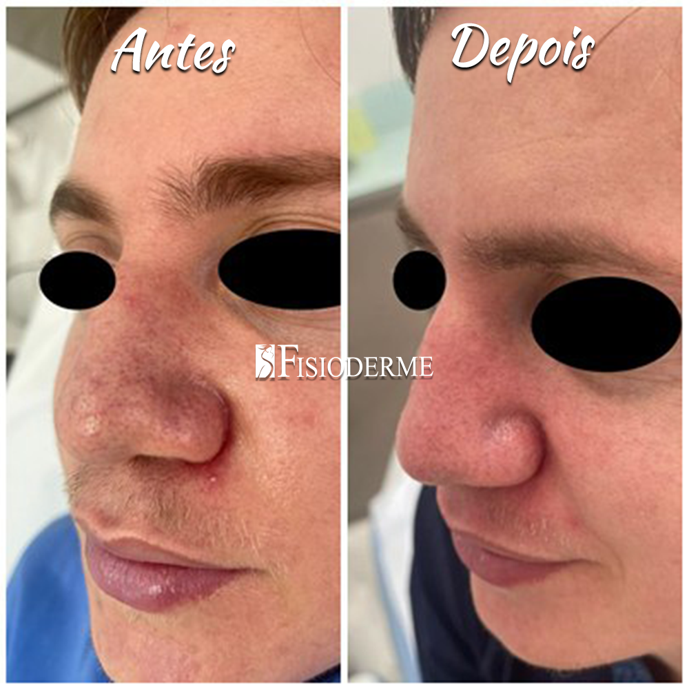 Alimentos e Suplementos para Fortalecer os Vasos Sanguíneos da Face