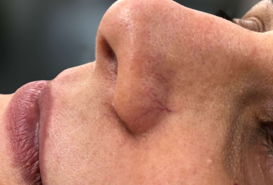 Laser Transdérmico vs. Escleroterapia: Qual o melhor para vasinhos no rosto?