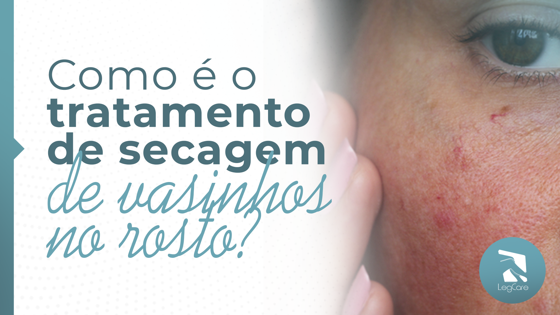 Rosácea e Vasinhos: Entenda a Conexão e Como Tratar