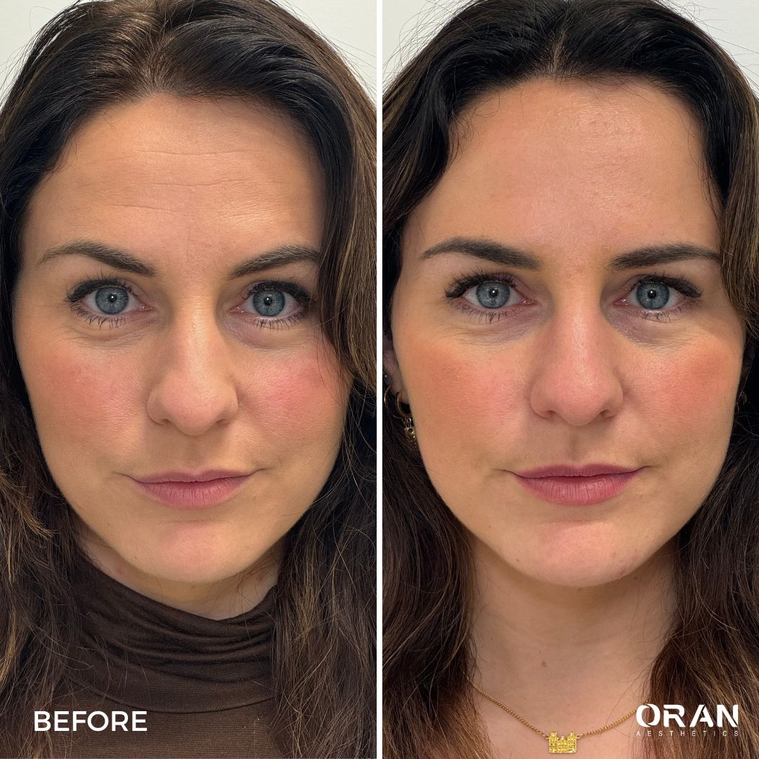 microbotox