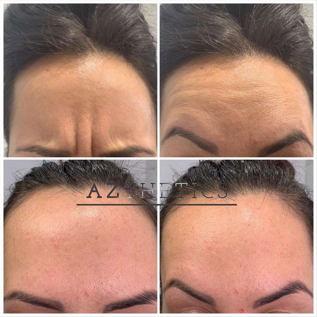 toxina botulínica preventiva