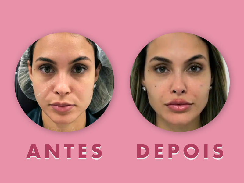 preenchimento bigode chinês preço