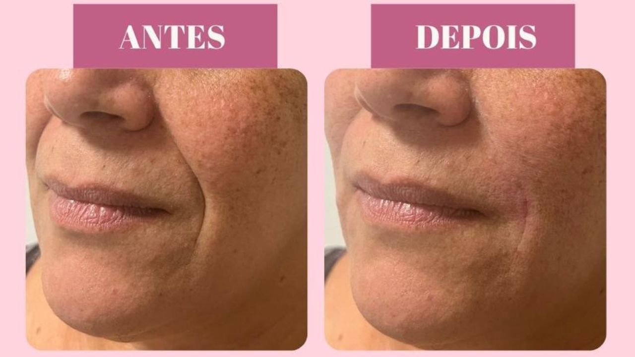 ácido hialurônico bigode chinês dura quanto tempo