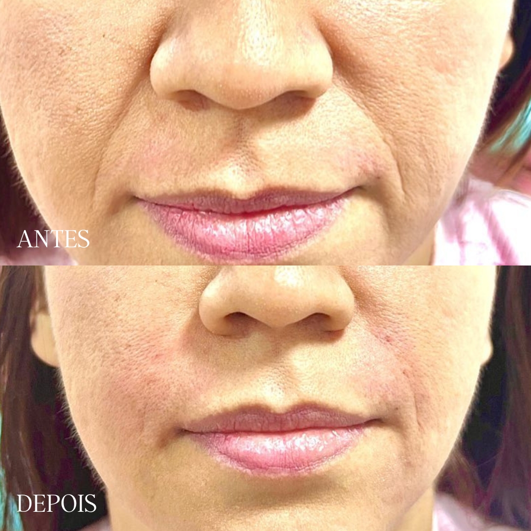 harmonização facial bigode chinês