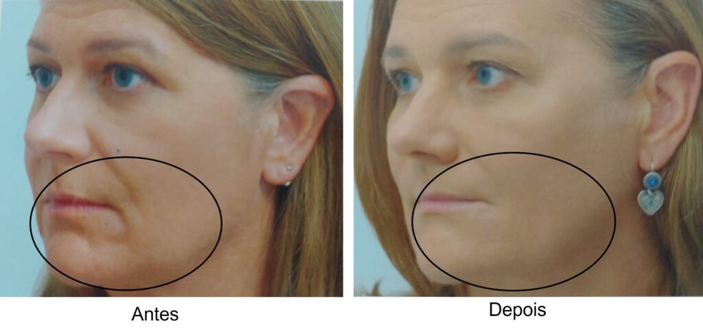 antes e depois sculptra bigode chinês