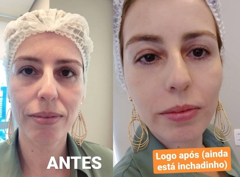 custo preenchimento bigode chinês