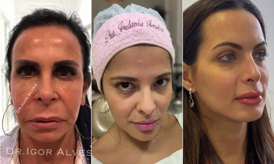 tratamento rugas ao redor da boca