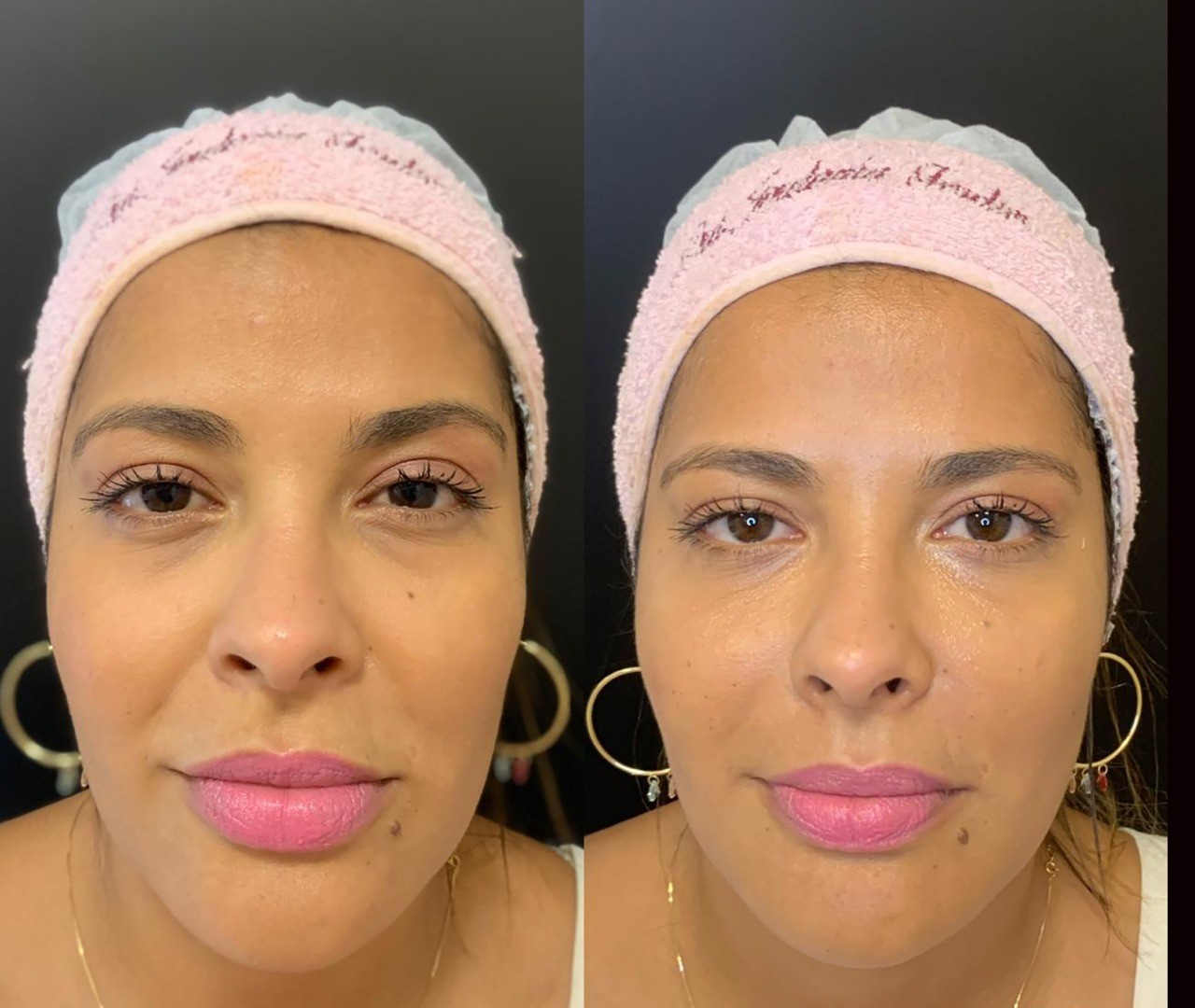 harmonização facial bigode chinês