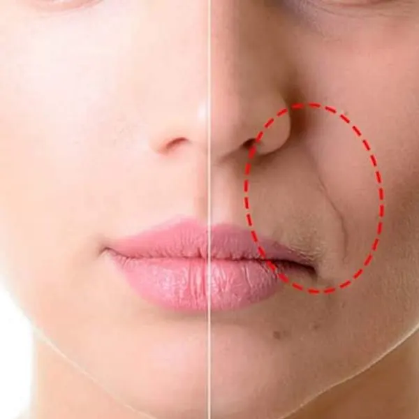 antes e depois sculptra bigode chinês