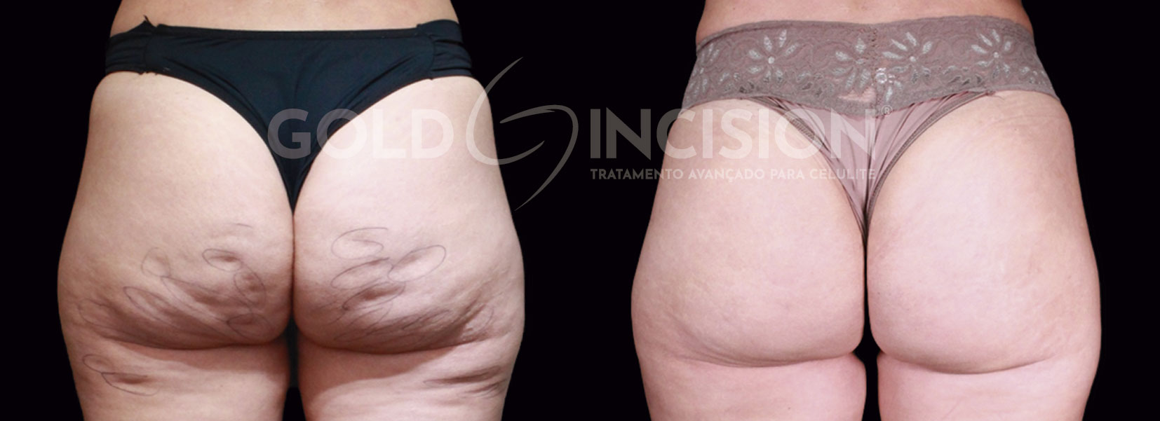 tratamento celulite antes e depois