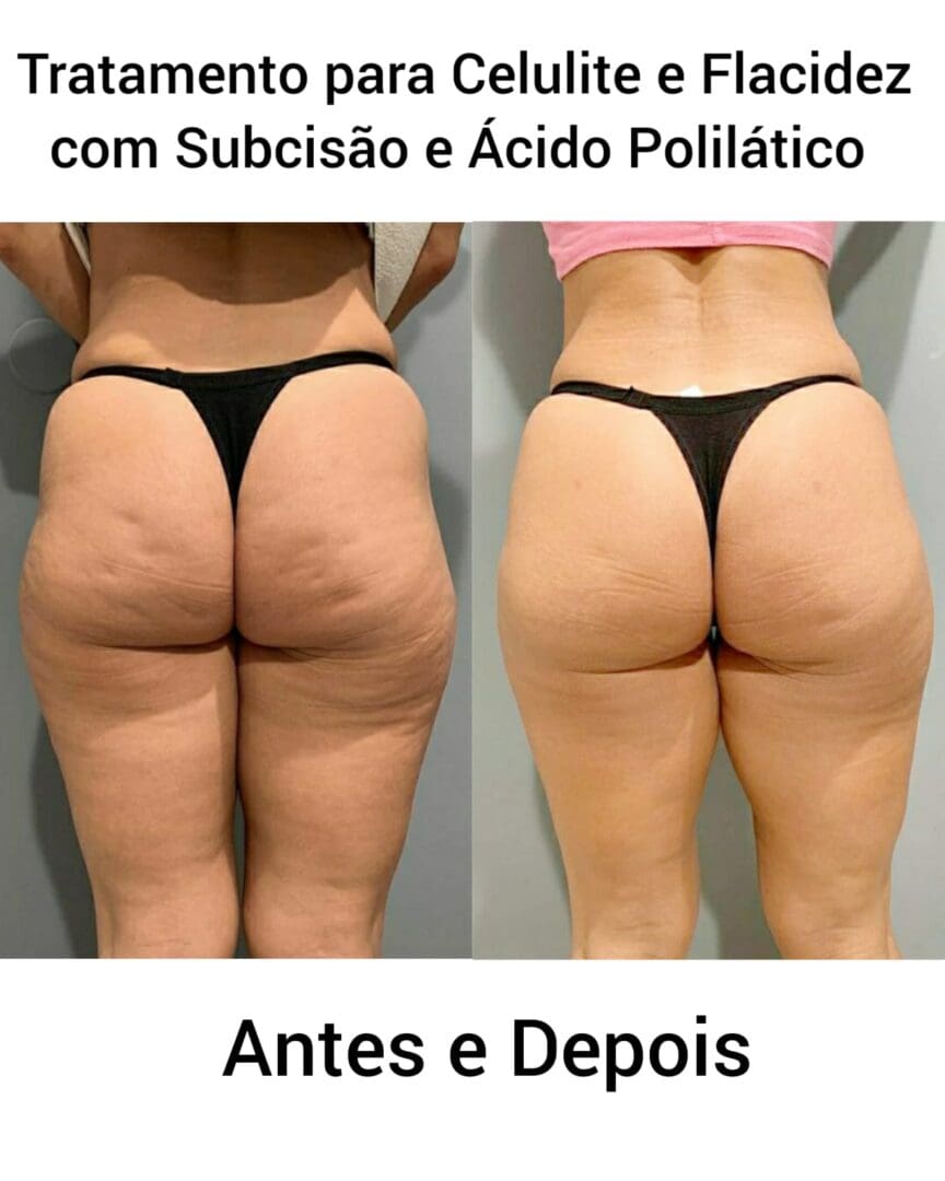 fotos celulite antes e depois