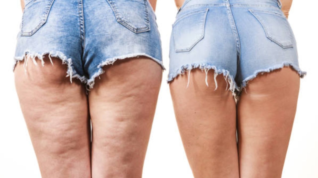 celulite pós-parto antes e depois