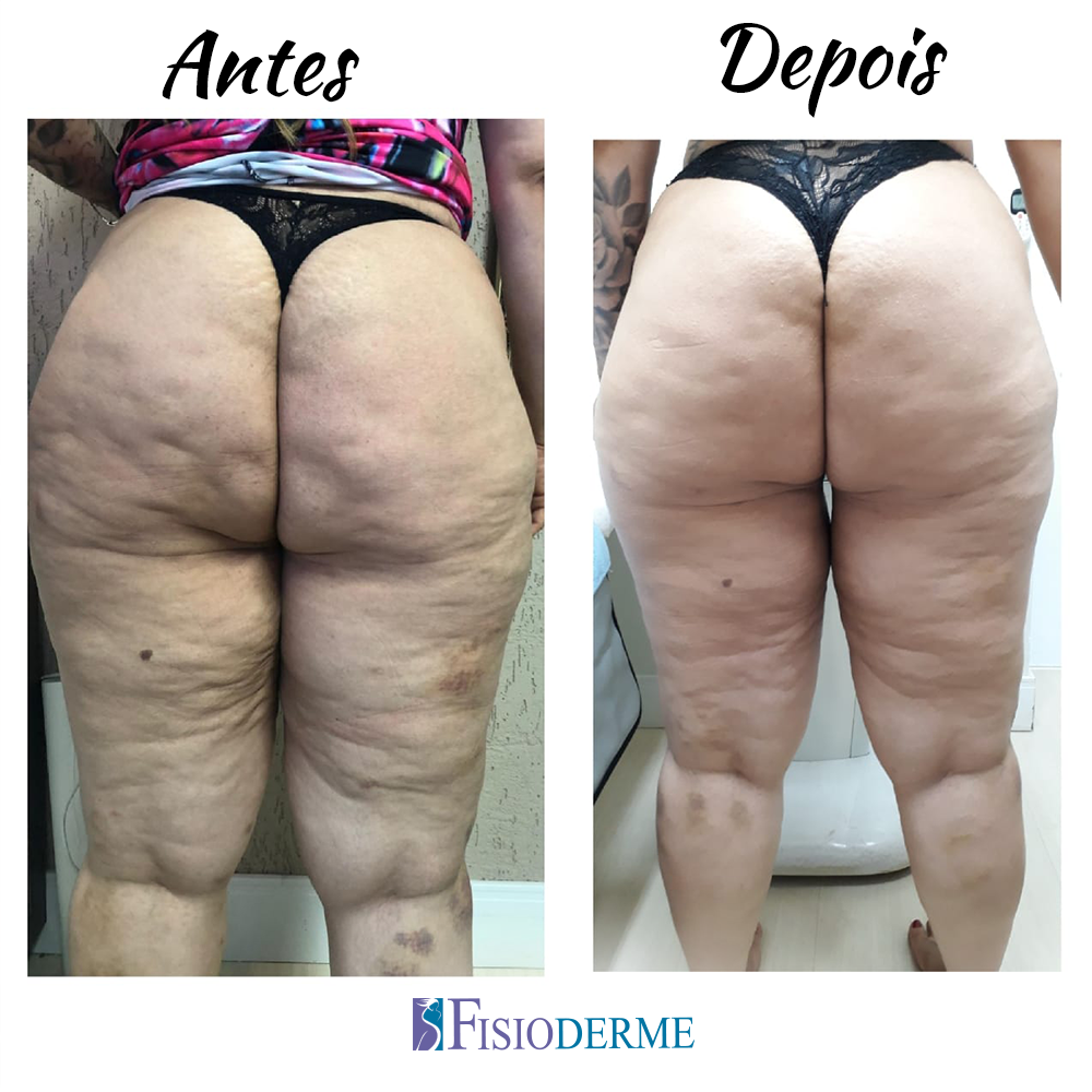 celulite emagrecimento antes e depois