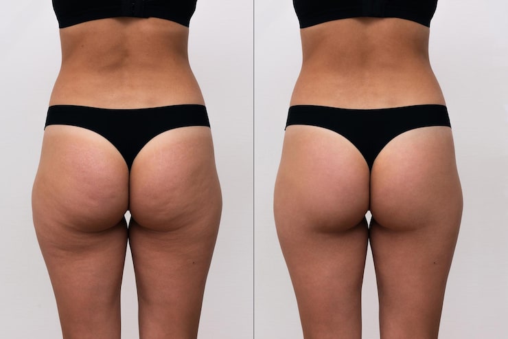 tratamento celulite antes e depois
