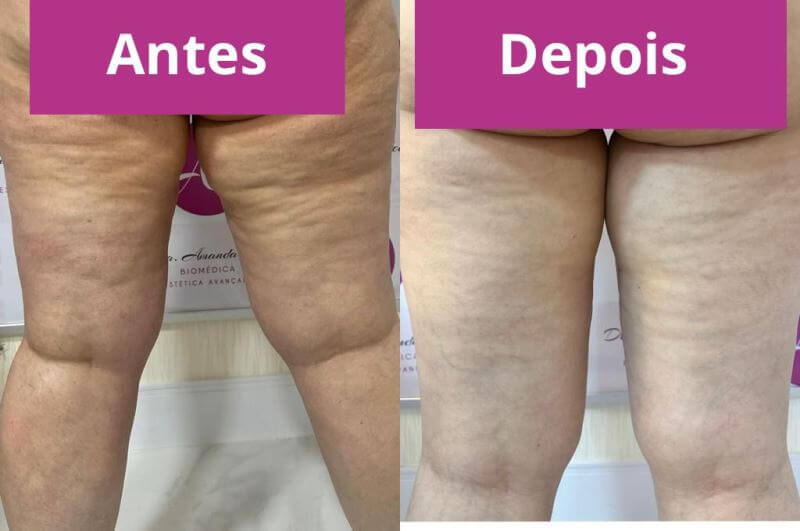 fotos celulite antes e depois