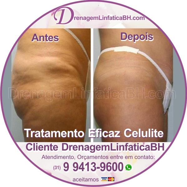 melhor tratamento celulite