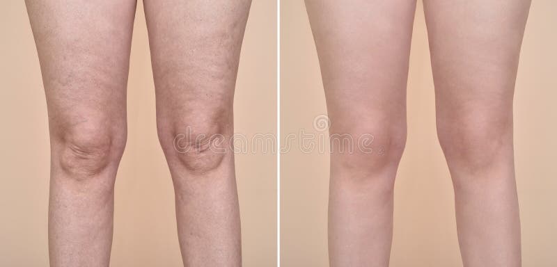 celulite pernas antes e depois
