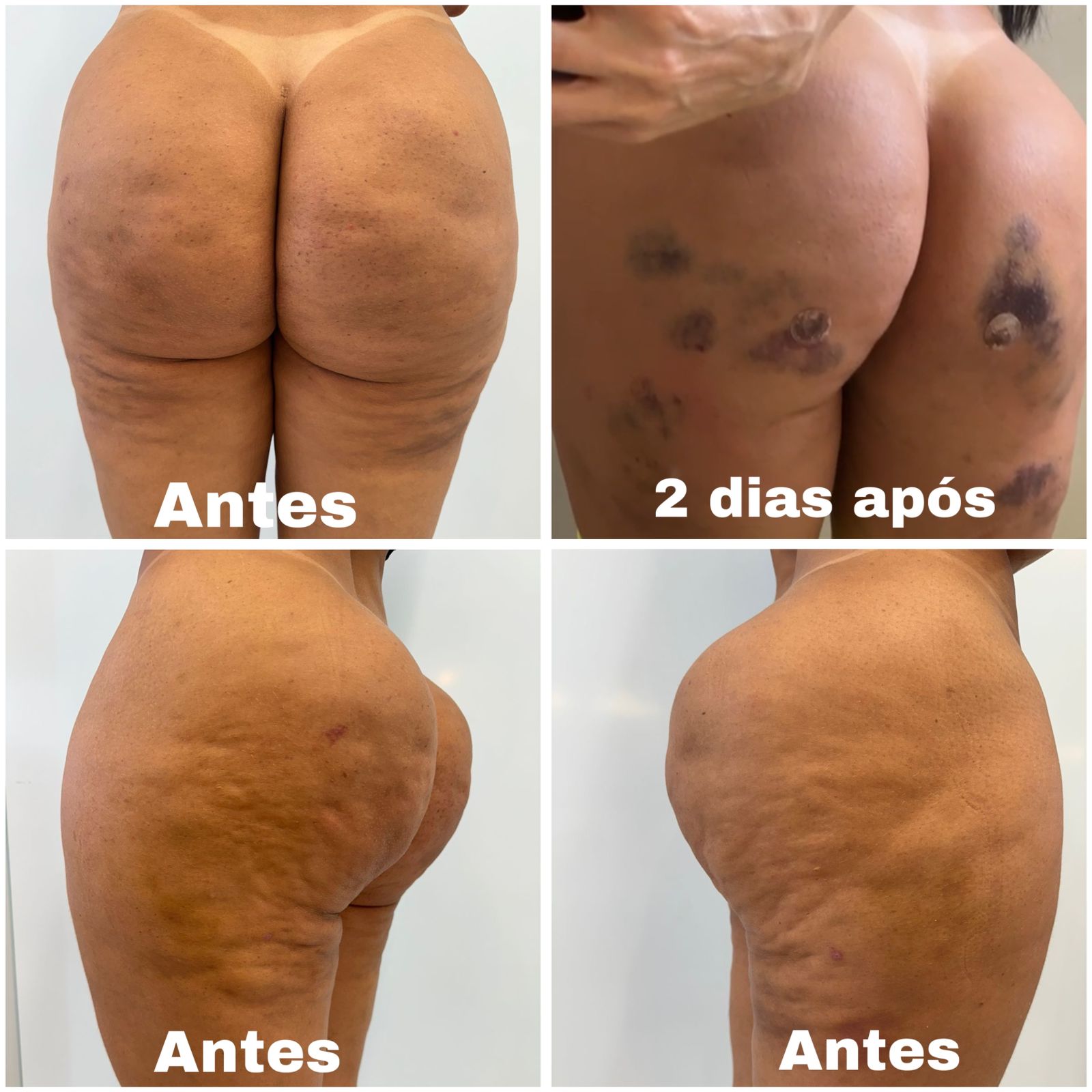 celulite glúteo antes e depois