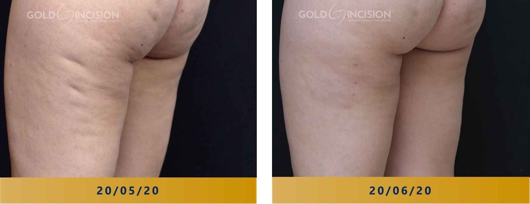 exercícios para celulite