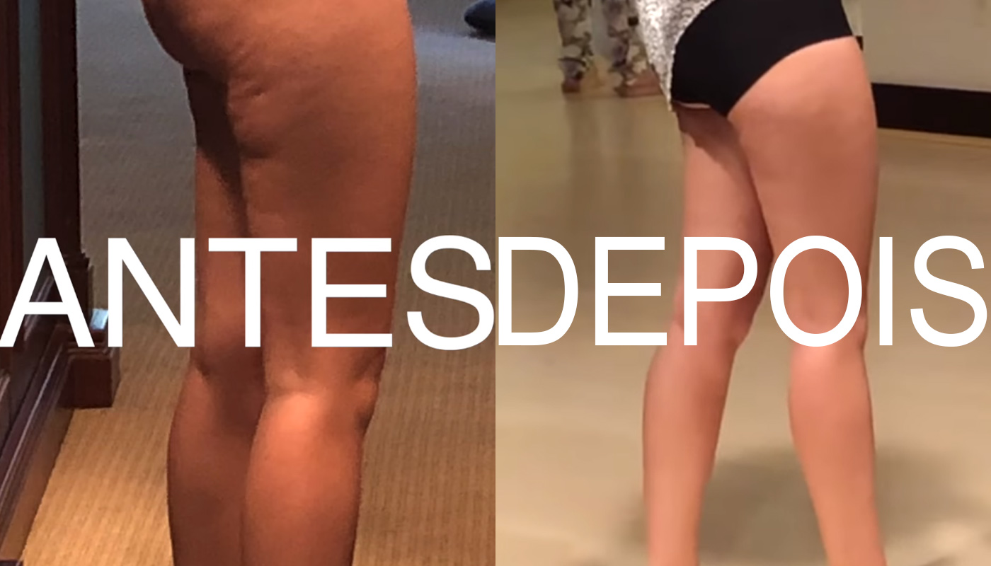celulite e flacidez diferença