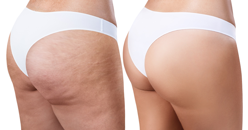 celulite pernas antes e depois