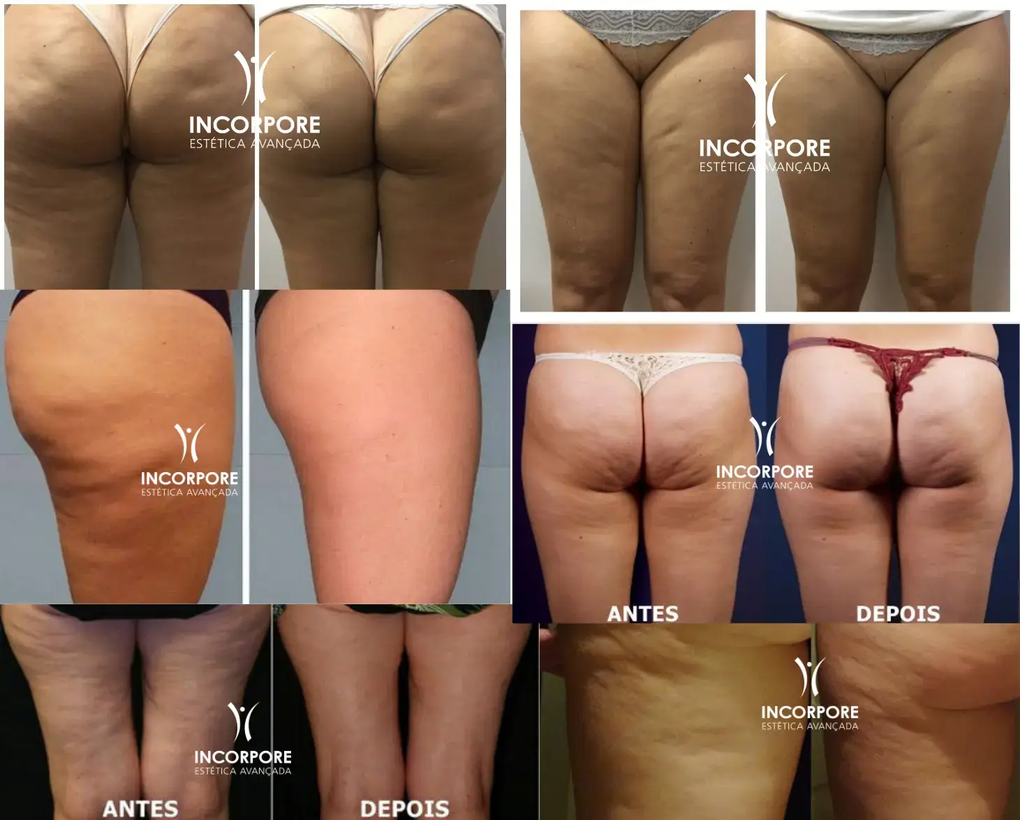 reduzir celulite visualmente
