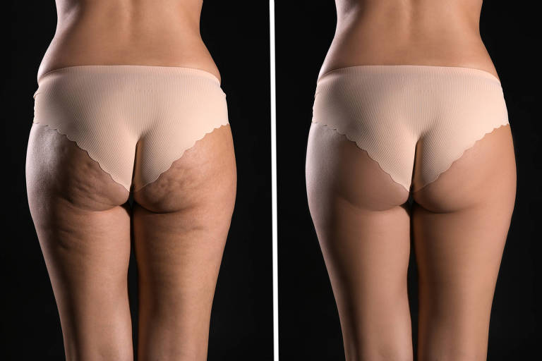 exercícios para celulite
