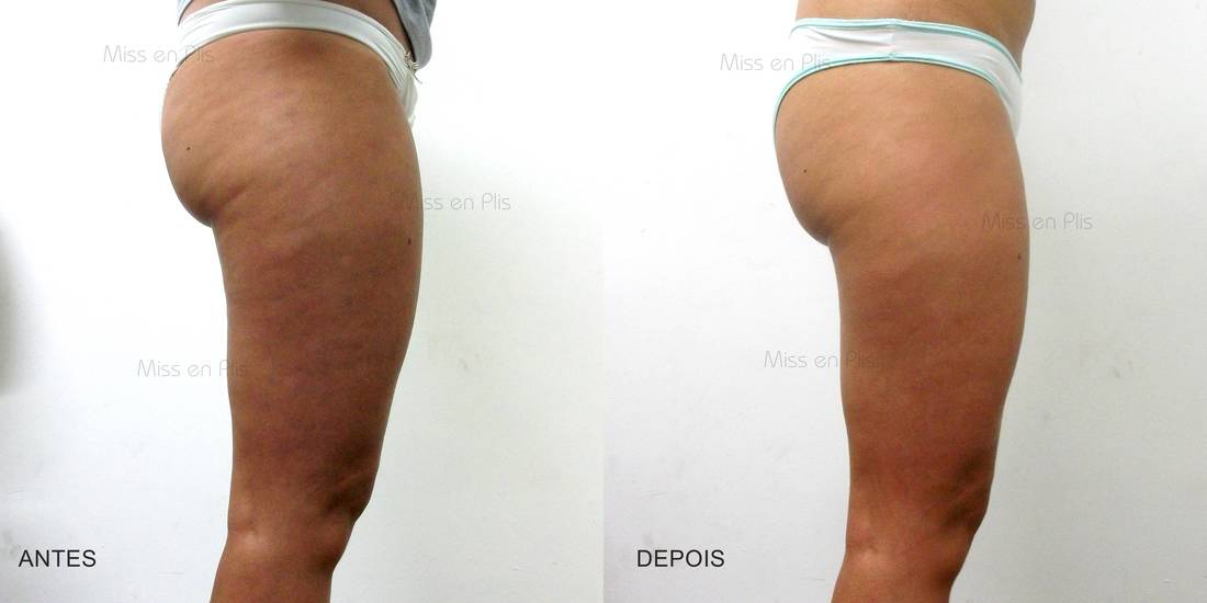 celulite e flacidez diferença
